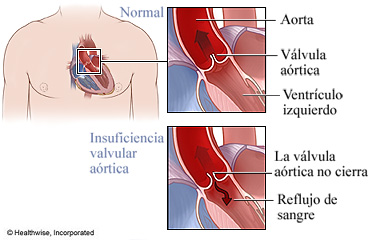 Válvula aórtica normal e insuficiencia valvular aórtica