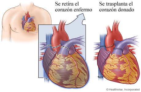 Corazón enfermo que muestra dónde se separaron los vasos sanguíneos, y corazón trasplantado que muestra dónde se unieron los vasos sanguíneos