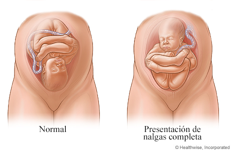 Imágenes de presentación normal y presentación de nalgas completa del feto