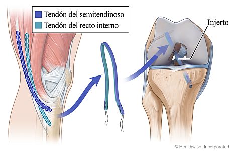 Injerto de isquiotibiales para la cirugía del LCA, en la que se muestran los tendones usados y el injerto colocado en los huesos de las partes superior e inferior de la pierna