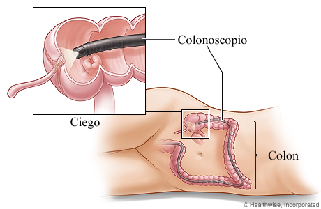 Colonoscopio en el colon
