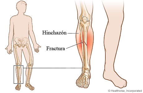 Imagen de una fractura en la parte inferior de la pierna