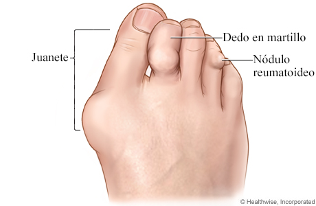 Imagen de la artritis reumatoide en el pie