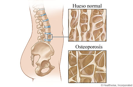 Hueso sano comparado con uno debilitado por osteoporosis