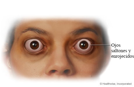 Ojos saltones y enrojecidos de la oftalmopatía de Graves