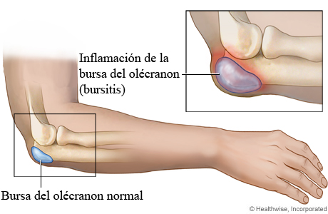 Una bursa del codo normal comparada con una bursa inflamada (bursitis)