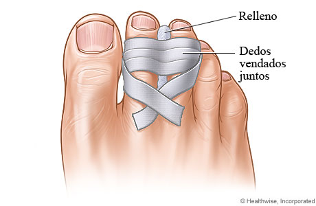 Dedo del pie roto pegado al dedo sano adyacente, con acolchado entre los dedos.