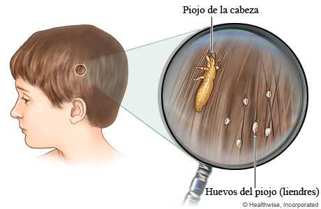 Imagen de cómo se ven los piojos de la cabeza y sus huevos (liendres) en el cabello