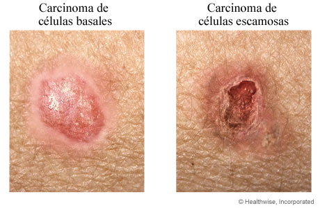 Ejemplos de carcinoma de células basales y escamosas