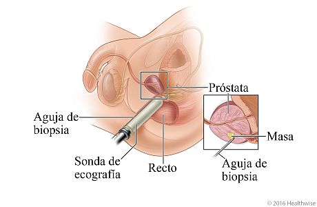 Imagen de una biopsia transrectal de próstata