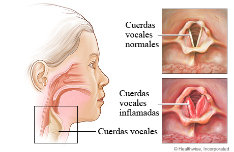 Cuerdas vocales inflamadas en la laringitis