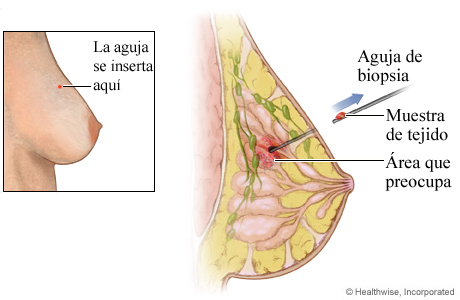 Biopsia de seno con aguja gruesa