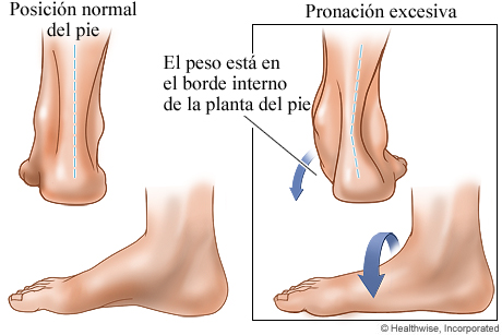Posición normal del pie y pronación excesiva