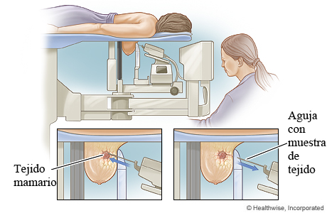 Biopsia estereotáctica del seno