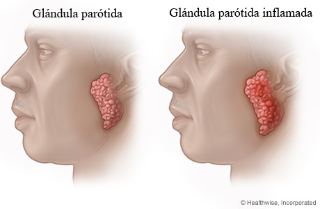 Glándula parótida normal y glándula parótida inflamada