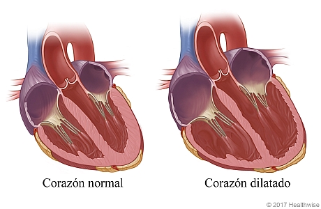 Corazón normal y un corazón agrandado (dilatado).