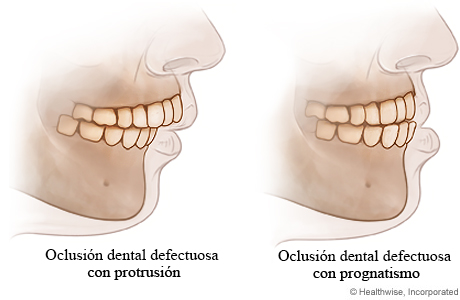 Oclusión dental defectuosa con protrusión y con prognatismo