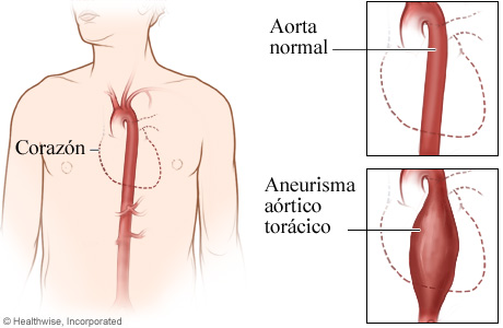Una aorta normal y un aneurisma aórtico torácico