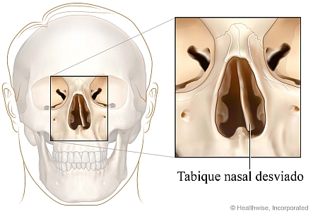Tabique nasal desviado