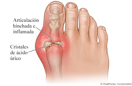 Imagen de la gota en el dedo gordo del pie
