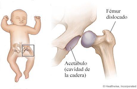 Displasia de cadera en un niño