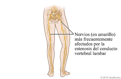 Ubicación de los nervios en las piernas que están más frecuentemente afectados por la estenosis espinal lumbar