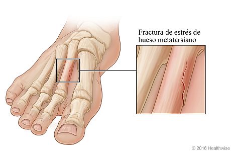 Vista ósea del pie, con detalle de fractura de estrés en un hueso metatarsiano