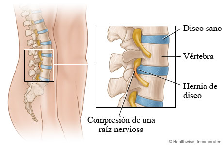 Imagen de una hernia de disco (vista lateral)