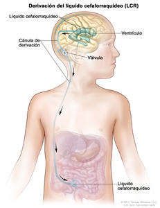 En el dibujo de la cabeza y el cuerpo de un niño, se muestra el recorrido que hace el LCR de color azul que fluye por una cánula de derivación (tubo largo y delgado) desde un ventrículo (espacio lleno de líquido) del encéfalo hacia el abdomen. La cánula se coloca en un ventrículo dentro de la cabeza, pasa por debajo de la piel del cuello y el tórax, y llega hasta el abdomen. Se señala en la cánula de derivación una válvula que controla la dirección del flujo de LCR. En el dibujo también se observa el encéfalo, rodeado por LCR azul y las vísceras del abdomen.