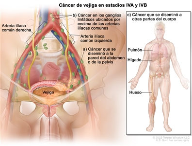 Cáncer de vejiga en estadios IVA y IVB. En la imagen se observa cáncer que se diseminó de la vejiga a la pared del abdomen o de la pelvis (a); y a los ganglios linfáticos ubicados por encima de las arterias ilíacas comunes (b). En el recuadro se observa cáncer que se diseminó a otras partes del cuerpo, como el pulmón, el hígado y el hueso (c).