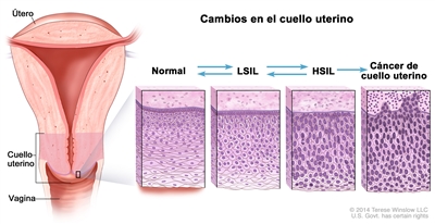 Cambios en el cuello uterino; en la ilustración se muestra un corte trasversal del útero, el cuello uterino y la vagina. También se muestran cuatro paneles con cambios celulares dentro del cuello uterino. En el primer panel, se muestran las células normales; en el segundo y el tercero, se muestran las células anormales que se llaman LSIL y HSIL y en el cuarto, se muestran las células cancerosas en el cuello uterino. Se usan flechas entre los paneles para indicar que las células normales se pueden convertir en LSIL o HSIL que, a su vez, se pueden convertir o no en cáncer.