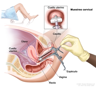 Muestreo cervical. En la imagen se observa una vista lateral anatómica del aparato reproductor femenino. Se observa un espéculo que abre la vagina. Además, se muestra una mano enguantada que introduce un cepillo en la vagina para obtener células del cuello uterino en la base del útero. También se observa el recto. En un recuadro, se observa el cepillo tocando el centro del cuello uterino. En otro recuadro, se muestra a una mujer cubierta con una sábana, acostada en una camilla con las piernas separadas y los pies apoyados en unos soportes.