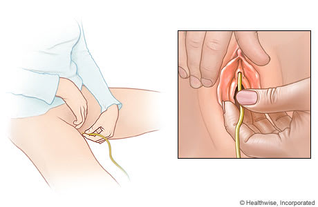 Person spreading the labia and inserting catheter into the urethra opening, above the vagina.