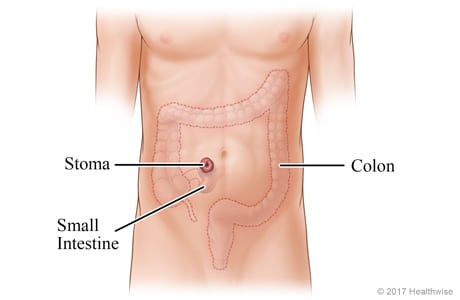 Colon and small intestine, with small intestine attached to stoma