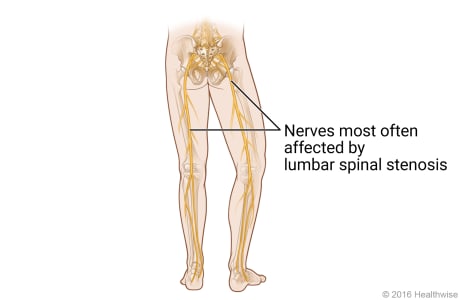 Nerves most often affected by lumbar spinal stenosis Video & Image