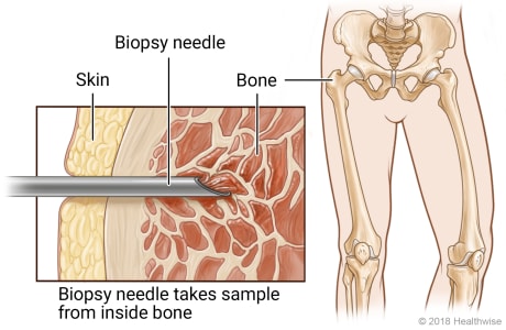 Skeletal view of lower body, with cross-section view of biopsy needle taking sample of bone