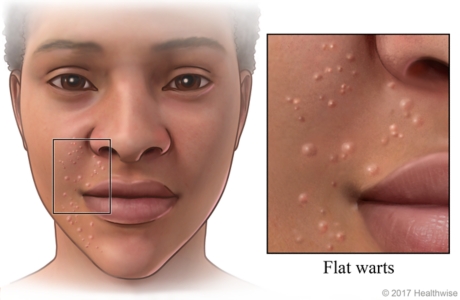 Area on side of face covered with small flat warts with close-up of small bumps.