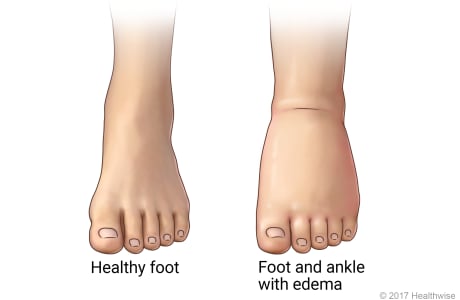 Normal foot and ankle, and foot and ankle with edema