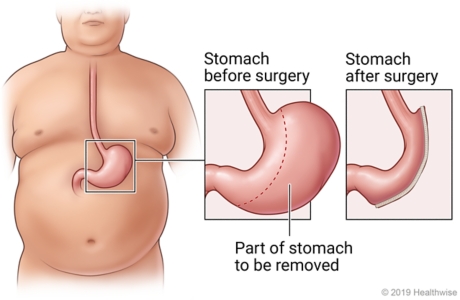 Gastric Sleeve Surgery - Health Library