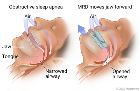 Sleeping person with narrowed airway from sleep apnea, and then using MRD showing jaw moved forward and airway opened