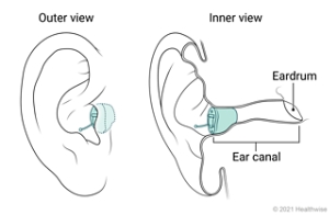 Outer and inner views of completely-in-the-canal hearing aid placed in ear.