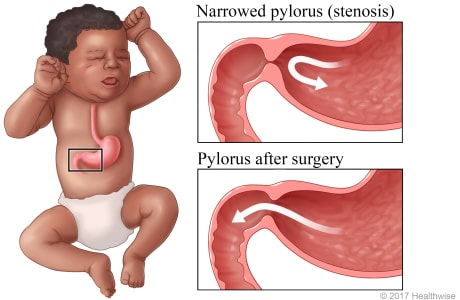 Pylorus between stomach and small intestine, with detail showing narrowed pylorus sphincter muscle (stenosis) before surgery and widened pylorus after surgery.