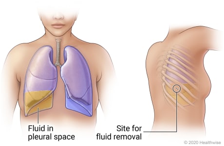 Lungs in chest showing fluid in right pleural space, and view of person's back showing site between two ribs for fluid removal.
