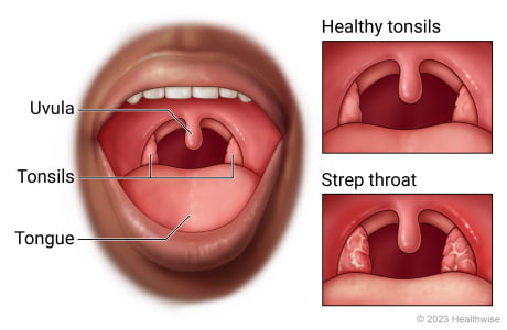 Open mouth showing throat, uvula, tonsils, and tongue, with detail of healthy tonsils and strep throat.