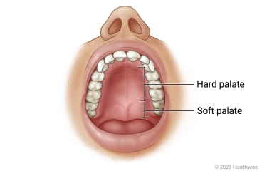 Roof of open mouth showing hard palate and soft palate.
