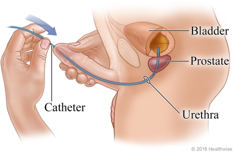 Side view of catheter inserted through the urethra in the penis and up into the bladder.