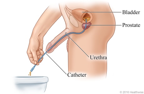 Side view showing urine draining through the catheter, from the bladder into the toilet.