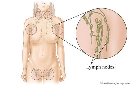 Lymph system throughout body, with close-up of lymph nodes in armpit area.