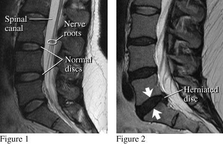 Understanding Your Lumbar Spine MRI