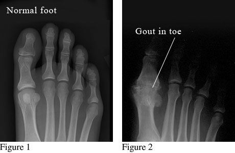 X-ray images of a normal foot and a foot with gout in the big toe